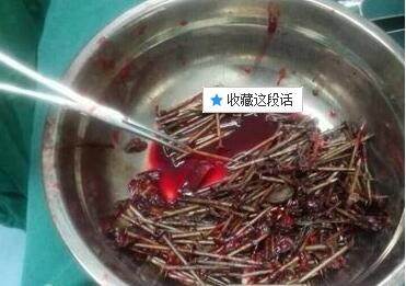 江西15岁少年身体不适 胃中取出200余钉子