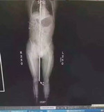 男子被钢筋贯穿全身 30名专家抢救7小时