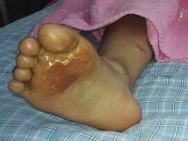 小学生37度高温被罚光脚跑 脚掌被烫伤红肿溃烂