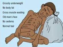 全球1/3的人营养不良