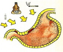 我国肠胃病患者1.2亿 七恶习伤肠胃