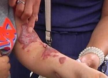 6岁男童在幼儿园烫伤 家长称不给200万就堵门