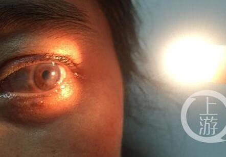 40岁女子移植猪眼角膜 视力大部分可恢复