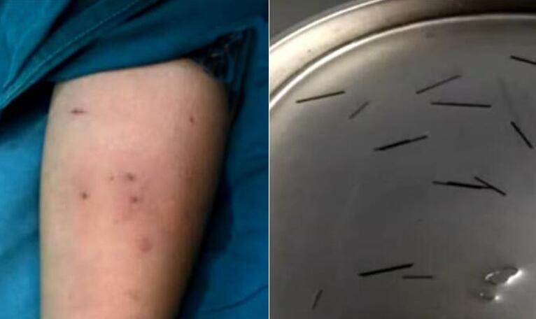 女孩手臂扎18截铅笔芯 为提神做作业