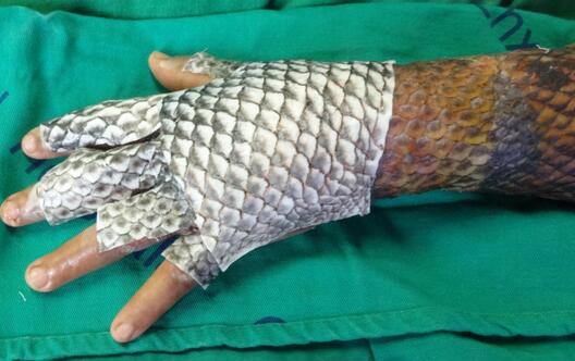巴西女子手臂烧伤后植入鱼皮