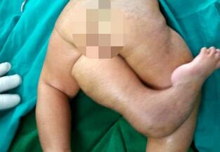 女婴通过手术成功切除&ldquo;第三条腿&rdquo;