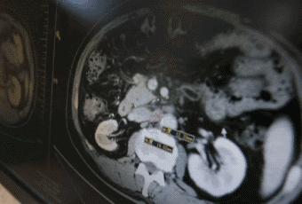 中国正研制世界最新抗癌药 一年治疗费不超10万