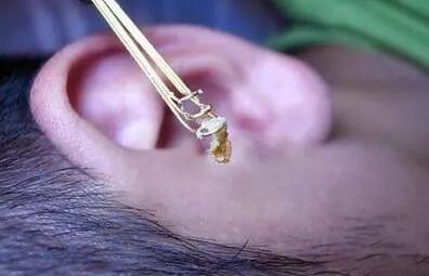 耳屎究竟需不需要掏？很多人都做错了