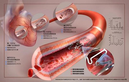 首创全球最低载药量心脏支架可媲美欧美金标准产品