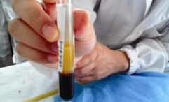 25岁小伙突然晕倒抽出的血全是油这个习惯害苦他