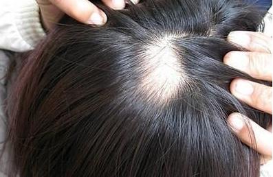 脱发年轻化？不，精神压力是脱发第一诱因