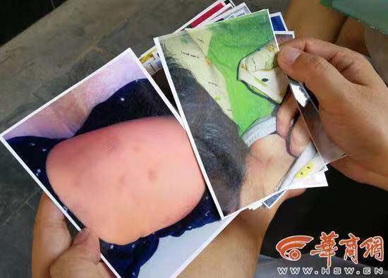 幼师背摔幼儿致其多处淤青 警方确认园方却拒赔