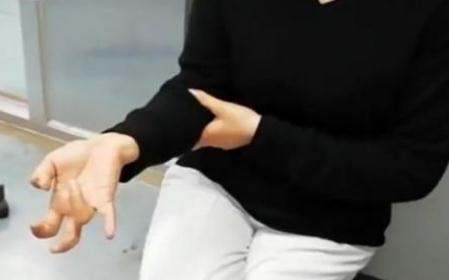 连续玩手机一周后她的右手“瘫痪”了