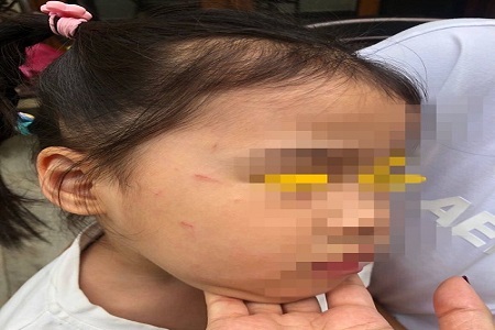 【评论】3岁女童入学2天18道伤痕事件：“哈罗”系学校怎能把孩子当成了“摇钱树”？！