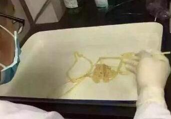 男子爱吃生肉 体内取出5米长寄生虫