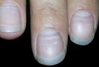 指甲上有白点有可能是得了肺气肿要小心对待