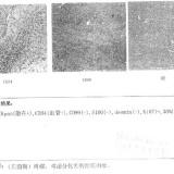 带走魏则西的“滑膜肉瘤”到底有多可怕