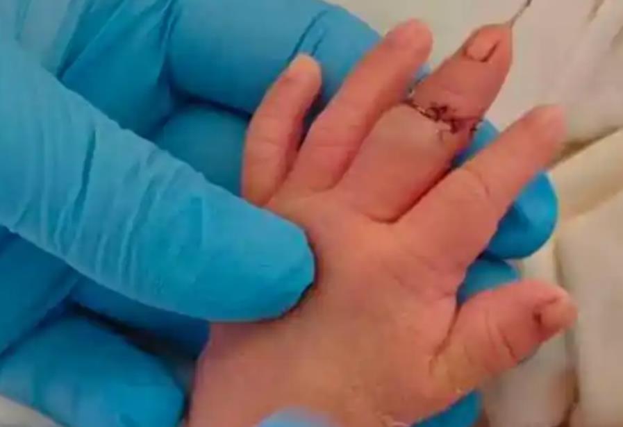 江苏盱眙&ldquo;断指新生儿&rdquo;事件达成和解，医疗安全流程漏洞敲响警钟