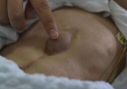 &ldquo;外心人&rdquo;男婴出生仅110天 可见心脏起伏跳动