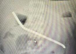 男子与女友拌嘴怒吞20厘米长钢筋