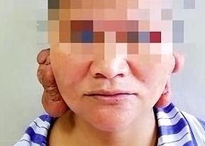 女子爱美打耳洞 十余年后耳垂长出肉疙瘩