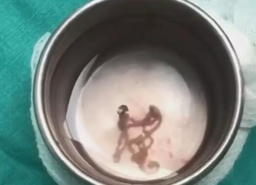 男子突发脸僵走不稳 医生从其脑干活捉30厘米长虫